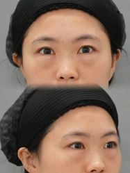 -天津健丽·去眼袋医疗美容机构