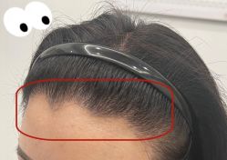 -大麦微针植发全国连锁