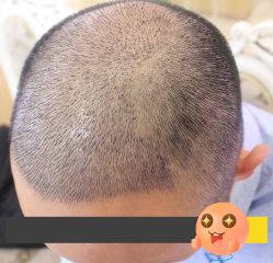 -大麦微针植发丨全国连锁