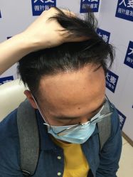 -大麦微针植发丨全国连锁