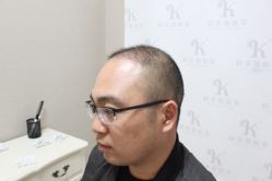 点击看大图 -大麦微针植发丨全国连锁