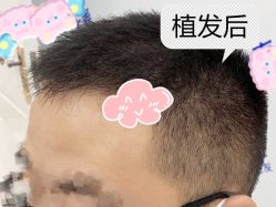 -大麦微针植发全国连锁