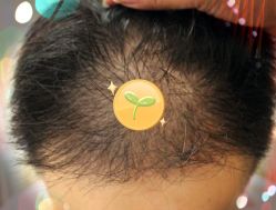 -大麦微针植发全国连锁