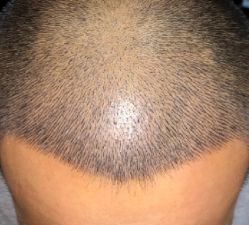 -大麦微针植发全国连锁