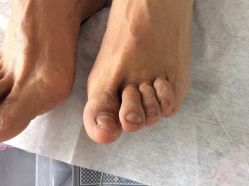 -德哥灰指甲脚气甲沟炎跖疣护理