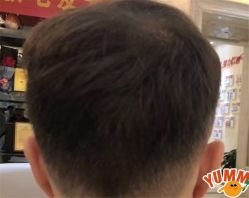 -大麦微针植发全国连锁