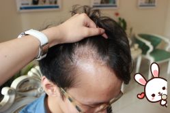 -大麦微针植发丨全国连锁