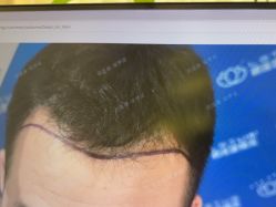 -碧莲盛·不剃发植发