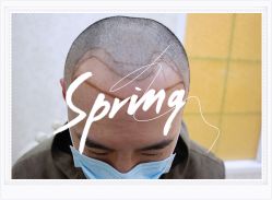 -大麦微针植发全国连锁