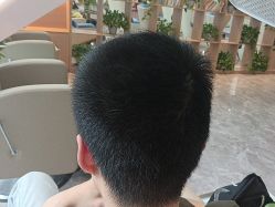 -碧莲盛·不剃发植发