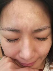 体验后-四川娇点医学美容医院