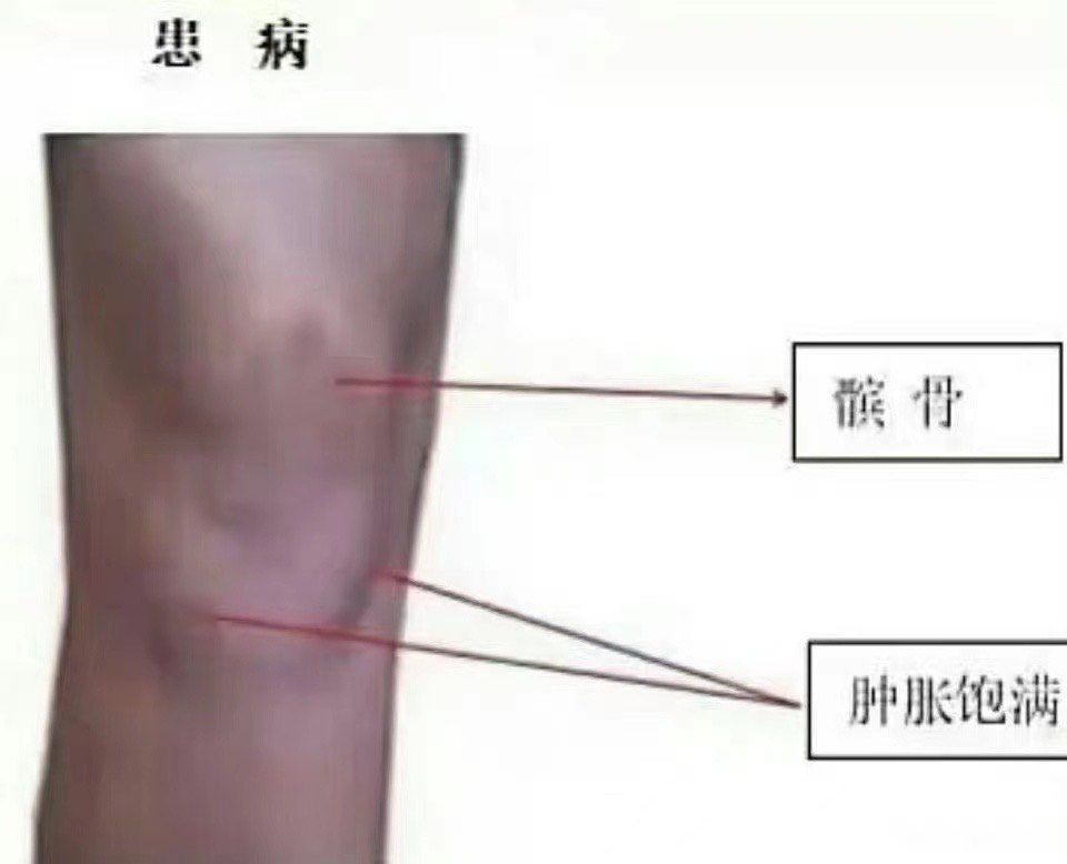 膝盖常见问题