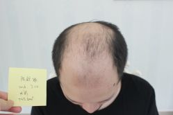 -大麦微针植发丨全国连锁