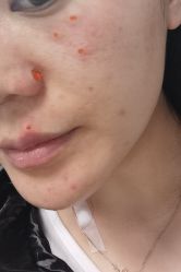 -百年美肤堂祛痦痣祛斑祛疣