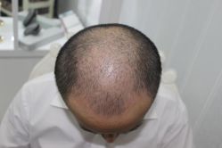 -大麦微针植发丨全国连锁