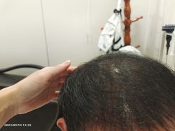 点击看大图 -碧莲盛·不剃发植发