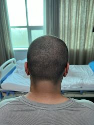 体验后-大麦微针植发全国连锁