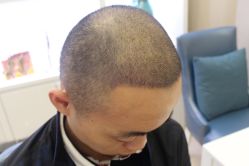 -大麦微针植发丨全国连锁