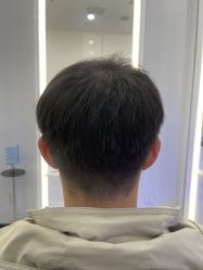 体验后-大麦微针植发全国连锁