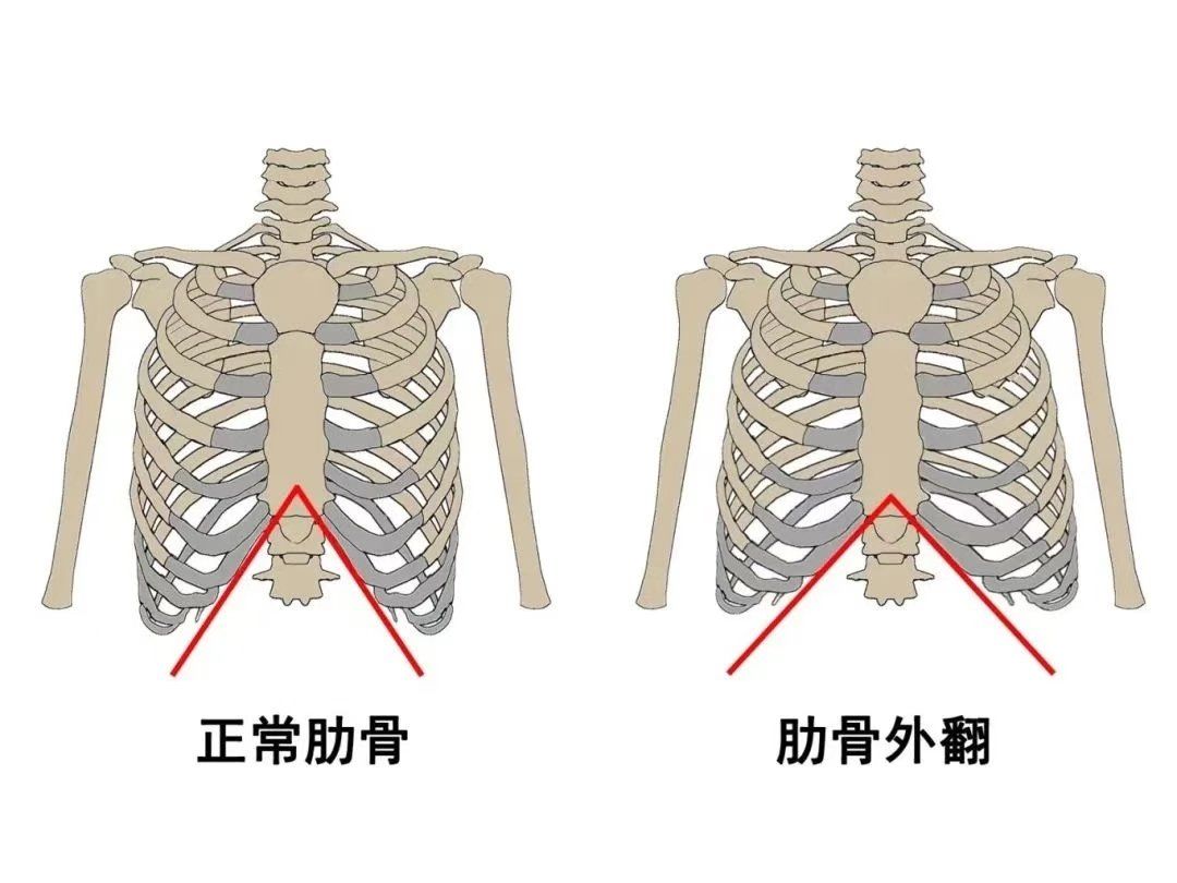 肋骨外翻