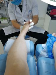 -派恩宜灰指甲鸡眼嵌甲手足癣