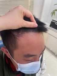 -大麦微针植发丨全国连锁
