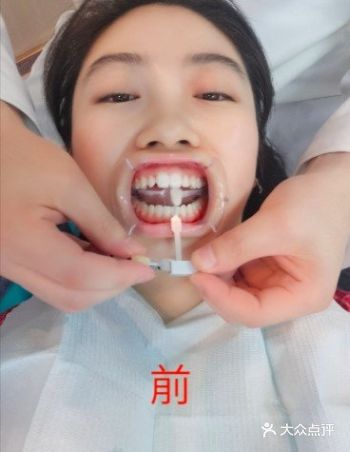 考虑了好久我终于下定决心做皓齿美白啦…… 第一次做美