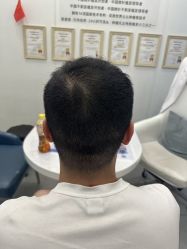 -大麦微针植发全国连锁