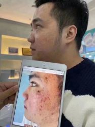 -蕾特恩专业祛痘