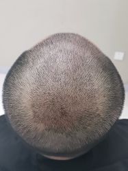 点击看大图 体验后-大麦微针植发全国连锁