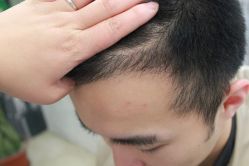 点击看大图 -大麦微针植发丨全国连锁