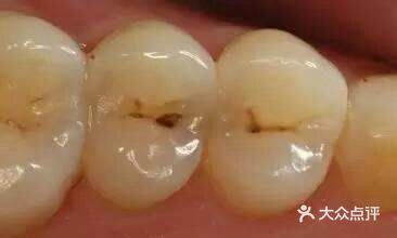 怎样鉴别孩子乳牙龋齿的程度[疑问]