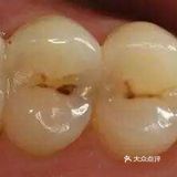 怎样鉴别孩子乳牙龋齿的程度[疑问]