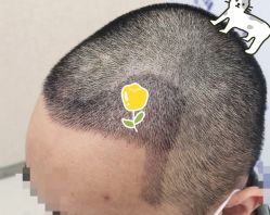 -大麦微针植发全国连锁