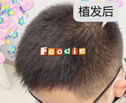 -大麦微针植发全国连锁