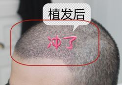 -大麦微针植发全国连锁