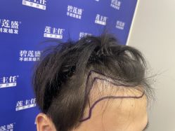 -碧莲盛·不剃发植发