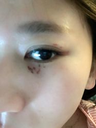 -美丽人生祛斑扁平疣汗管瘤中心