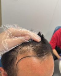 -大麦微针植发全国连锁