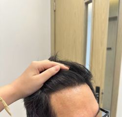 -大麦微针植发全国连锁