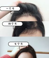 -大麦微针植发全国连锁