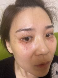 -美丽人生祛斑扁平疣汗管瘤中心