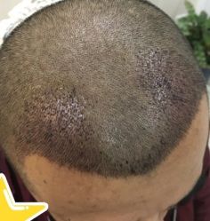 -大麦微针植发丨全国连锁