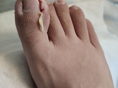 -世龙世家灰指甲鸡眼脚气甲沟炎跖疣护理(通州店)