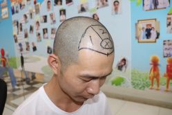 -大麦微针植发丨全国连锁