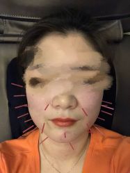-肥三针腧穴瘦身馆