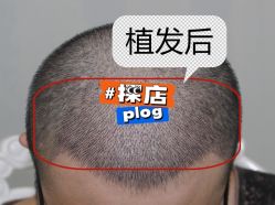 -大麦微针植发全国连锁