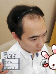 -大麦微针植发丨全国连锁