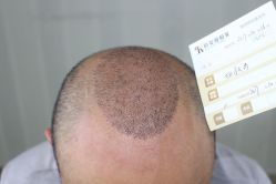 -大麦微针植发丨全国连锁