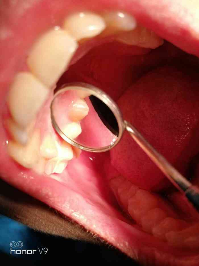 打分 点外卖吃过,咬到石子门牙右侧第三颗内侧缺了一块,最后美团只赔